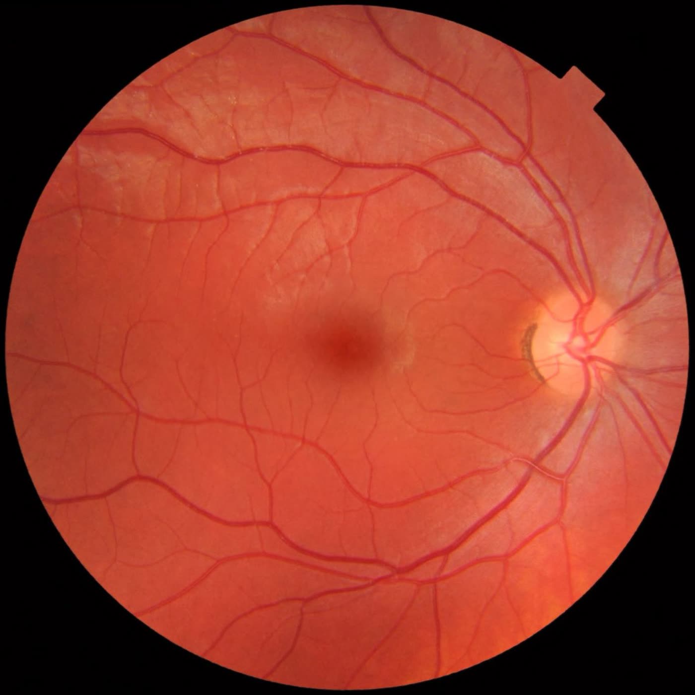 Retinal fundus photograph.