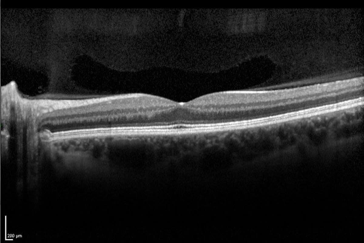 OCT cross-section of the retina.