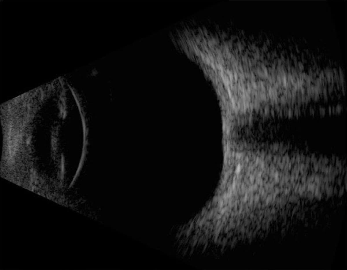 Ophthalmic ultrasound B-scan.